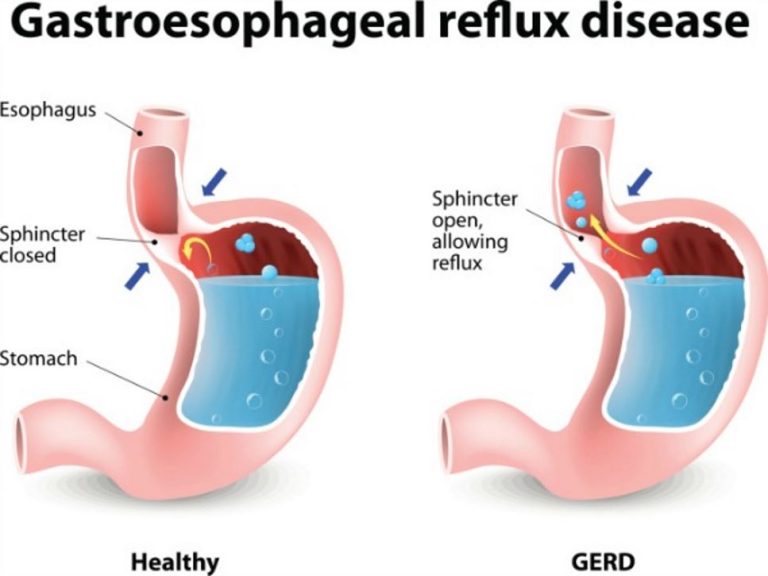 Can stress cause Gastroesophageal Reflux Disease (GERD)?