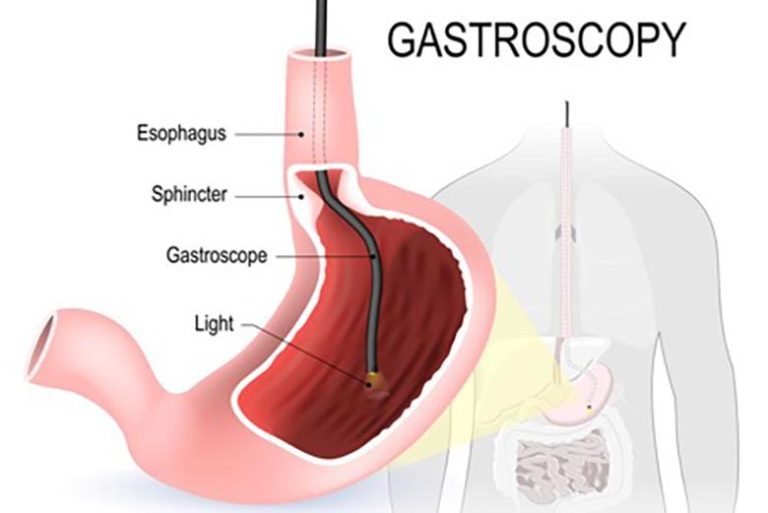 Gastroscopy Clinic Singapore: What to Expect and How to Prepare